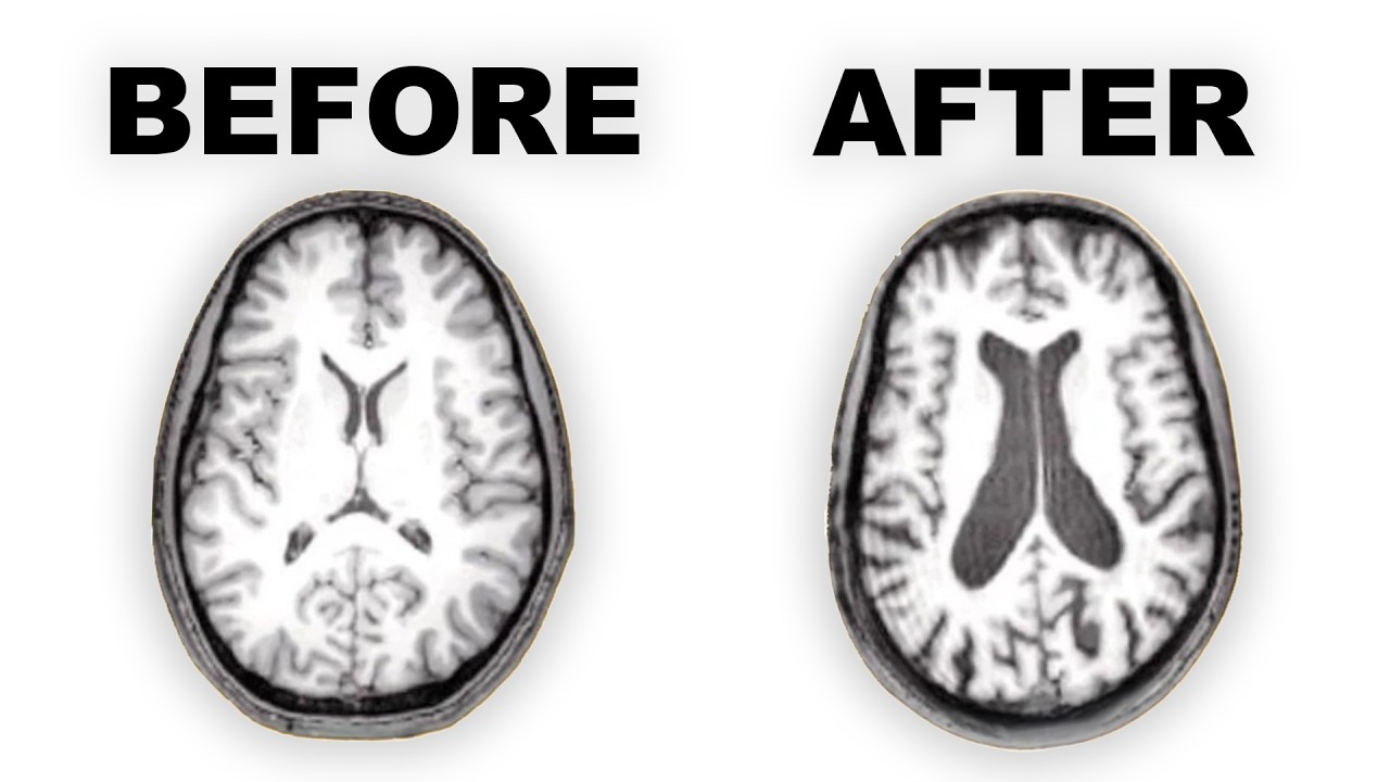 Long-term Effects of Antipsychotics on the Brain